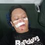 Wajah Terkena Selongsong Gas Air Mata, Mahasiswa Ini Terima 15 Jahitan