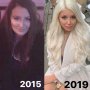 Remaja Ini Ingin Secantik Barbie, Nekat Filler Bibir Sejak Usia 13 Tahun