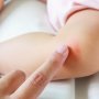 Belajar dari Kondisi Anak Mona Ratuliu, Kenali 6 Jenis Dermatitis!