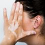 Bagaimana Membedakan Vitiligo dengan Bercak Putih Tanda Lahir pada Anak?