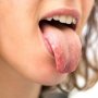 Penyebab Umum Munculnya Bintik Putih di Lidah, dari Cedera hingga Tumbuhnya Jamur