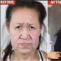 Minder Dikira Nenek di Usia 15 Tahun, Remaja Ini Akhirnya Operasi Plastik