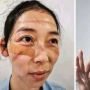 Wajah Petugas Medis di China Memar Terlalu Lama Pakai Masker