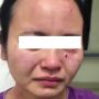 Tolak Jalani Perawatan, Pasien Positif Corona Gigit Wajah Perawat