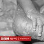Penyakit Cacar Diberantas dalam  200 Tahun, Bagaimana dengan Covid-19?