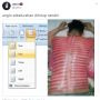 Ngakak, Foto Kerokan di Punggung Rapi Banget Kayak Tulisan Skripsi