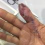 Terinfeksi Bakteri Pemakan Daging, Lelaki Ini Kehilangan Jari