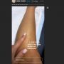 Mulanya Titik Kecil, Ternyata Perempuan Ini Derita Kanker Kulit