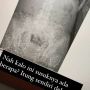 Viral Foto X-Ray Pasien Isinya Jarum Diduga Susuk, Jadi Trending di Twitter