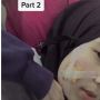 Sampai Operasi! Pipi Wanita Ini Infeksi Usai Pakai Masker saat Jerawatan