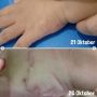 Penyebab, Gejala dan Cara Mengobati Cutaneous Larva Migrans