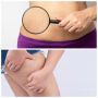 Cara Hilangkan Kulit Bergelambir Usai Berat Badan Turun: Wajah dan Tubuh Beda Gak Perlakuannya?