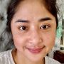 Dewi Perssik Pastikan Ruam Merah di Wajahnya Gejala Covid-19