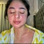 Ruam Kulit Dewi Persik Saat Covid-19 Akibat Varian Baru Virus Corona?