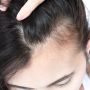 Simak! 3 Cara Menghilangkan Kutu Rambut Secara Alami