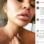 Bibir Chrissy Teigen Bengkak Usai Gigit Kulit Jeruk, Alergi?