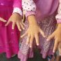 Anak-anak di Pontianak Diserang Penyakit Aneh, Namanya Scabies