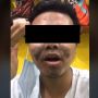 Kulit Wajah Pria Rusak Gegara Krim, Tak Kunjung Pulih sampai Mau Bunuh Diri