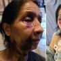 Disangka Keturunan Asia, Seorang Nenek Dianiaya hingga Patah Hidung