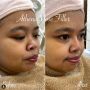 Kekeyi Filler Hidung, Ketahui Persiapan sebelum Melakukan Prosedur Kecantikan Ini