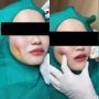 Viral Video Pembuatan Lesung Pipi Bikin Ngilu, Sampai Dijahit dan Ditarik