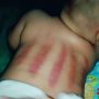 Takut Dibilang Corona, Ibu Ini Pilih Kerok Bayinya Sampai Kulitnya Memerah