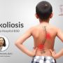 Peduli Pasien Skoliosis, Eka Hospital Kerjasama dengan Indonesia Scoliosis Community