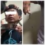 Sering Ngeluh Mimisan, Pas Dicek Ternyata Ada yang Bersarang di Hidung!