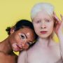 Serupa Tapi Tak Sama, Ini Perbedaan Vitiligo dengan Albinisme atau Albino