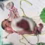 Sedih, Bayi di Kutim Lahir Tanpa Dinding Perut, Usus Keluar Lewat Lubang Samping Pusar