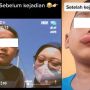 Bukan di Perut, Anak Ini Malah 'Kembung' di Bibir Sampai Jontor Usai Kena Angin