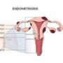 Fungsi Endometrium: Perannya Sangat Penting dalam Sistem Reproduksi Wanita