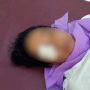 Sadis! Suami Siram Istri dengan Air Keras di Asahan