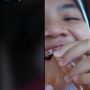 Ngakak! Cewek Ini Kesulitan Lepaskan Plastik Cilok yang Nyangkut di Behel