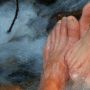Ketahui Penyebab Kutu Air, Obati dengan Cara Alami Pakai Bahan Dapur