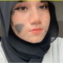 Viral Gadis Malaysia Dipenuhi Tanda Lahir di Wajah, Sering Diejek Tapi Malah Jadi 'Seleb' TikTok
