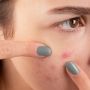 Ingin Beli Produk Skincare untuk Mengatasi Jerawat? Berikut 6 Bahan Aktif yang Dibutuhkan