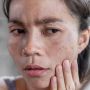 4 Skincare Lacoco untuk Hempaskan Noda Hitam, Brand Lokal Rasa Premium