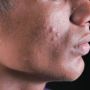 Benarkah Jarang Melakukan Hubungan Seks Bisa Bikin Jerawat Muncul? Ini Penjelasan Dokter Boyke