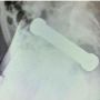 Pria Masukkan Dumbel 2 Kg Lewat Anus, Dokter Sampai Kewalahan Harus Operasi Pakai Tangan