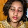 Selebgram Permesta Dhyaz, Anak Youtuber Farida Nurhan Alami Infeksi Implan Hidung, Dokter Tompi Ungkap Penyebabnya