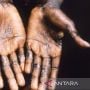 Muncul Kasus Pertama Virus Cacar Monyet di Denmark