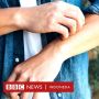 Ada Ruam di Kulit Anda? Cara Mengetahui Apakah Bercak Itu Cacar Monyet