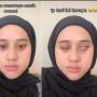 Viral! Gegara Keseringan Kena Kipas Angin, Wajah Perempuan Ini Alami Bells Palsy