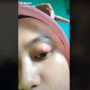Bintitan Selama Berbulan-bulan Ternyata Gara-gara Penyakit Kalazion, Kenali Gejala, Pengobatan, dan Pencegahannya
