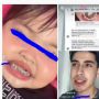 Viral Gigi Balita Diduga Dipasang Behel oleh Ibunya, Bikin Warganet Geram