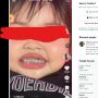 Viral Balita Menggunakan Behel Tuai Sorotan Publik, Kapan Waktu Ideal untuk Pasang Kawat Gigi?