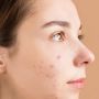 Makanan Sehari-hari yang Bisa Hilangkan Jerawat: Rahasia Wajah Mulus tanpa Skincare Khusus!