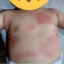 Tubuh Bayi Memerah Usai Ibu Minumkan Obat Resep dari TikTok, Warganet Emosi: Ngeyel