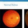 Tanda Awal Ablasio Retina, Dokter Haruskan Periksa jika Mendadak Muncul Bercak Hitam di Mata